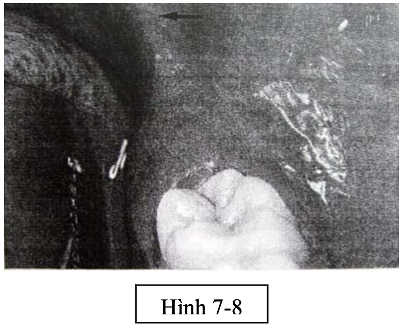 Phẫu thuật lấy mầm răng
